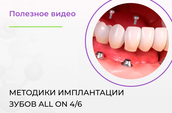 Методики имплантации зубов «Всё-на-4», «Всё-на-6»