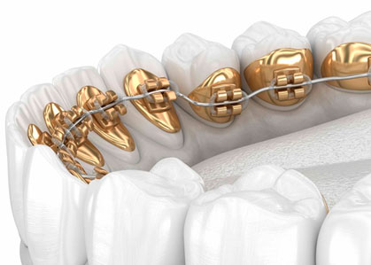 История ортодонтических брекетов
