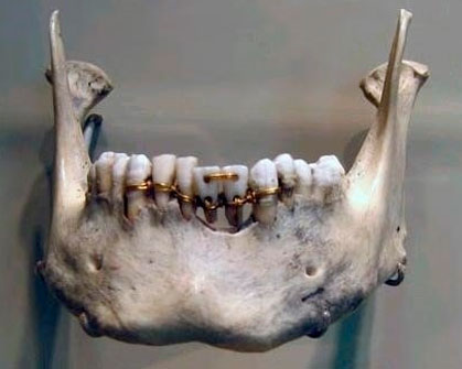История ортодонтических брекетов