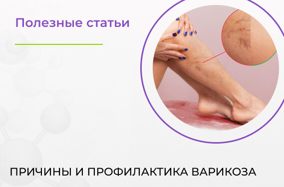 Причины и профилактика варикоза