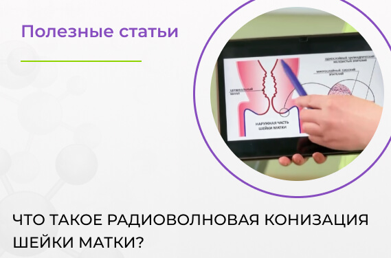 Что такое радиоволновая конизация шейки матки?