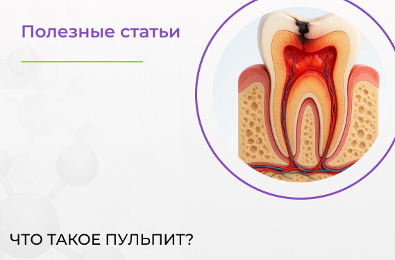 Как лечат пульпит