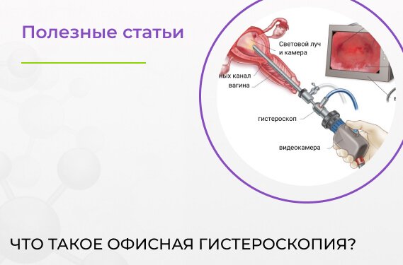 Что такое офисная гистероскопия?
