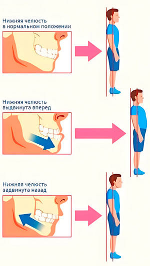 Влияние осанки на положение нижней челюсти