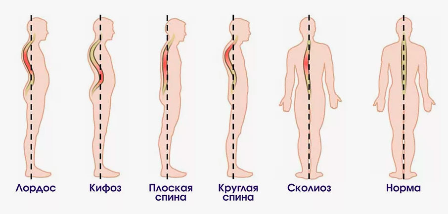 Искривление позвоночника