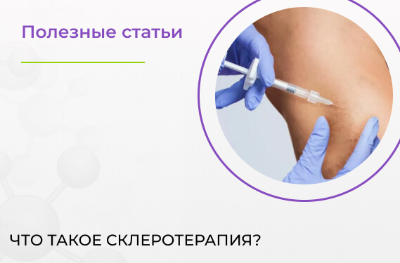 Что такое склеротерапия?