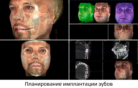 Томограф Planmeca ProMax 3D Mid - 3-d снимок