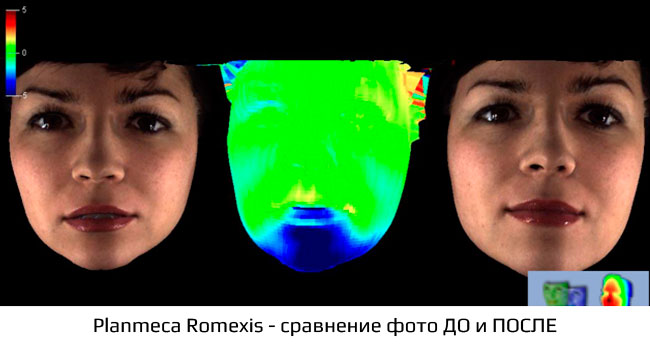 Томограф Planmeca ProMax 3D Mid - 3-d снимок