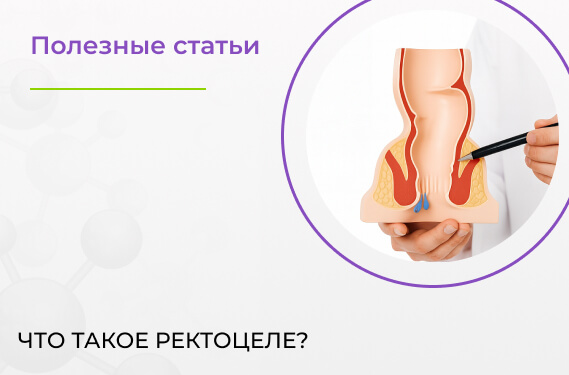 Что такое ректоцеле?