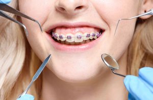 Installation of braces