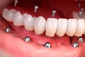 Dental Implantation All on 6