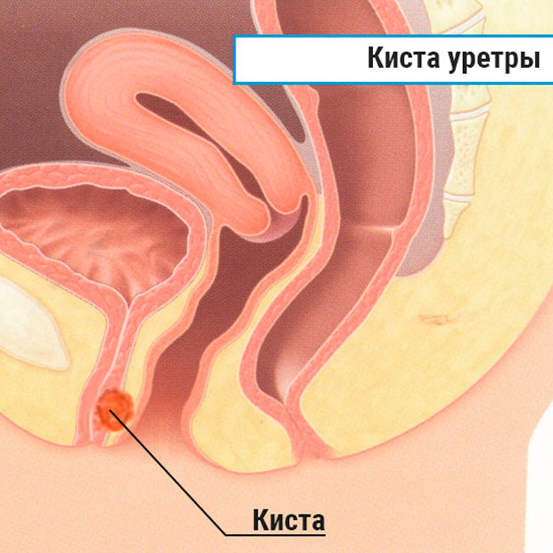 Иссечение парауретральной кисты