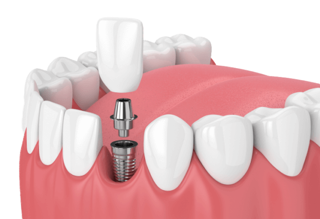 Нет 1-2 зубов - методики имплантации