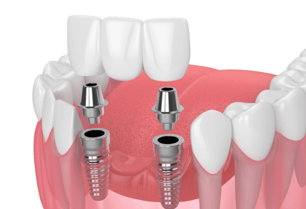 Нет 3-4 зубов подряд - методики имплантации