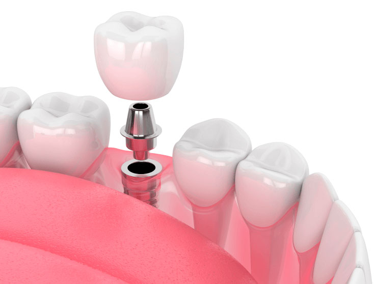 Имплантация зубов в Доткор ПРОФИ