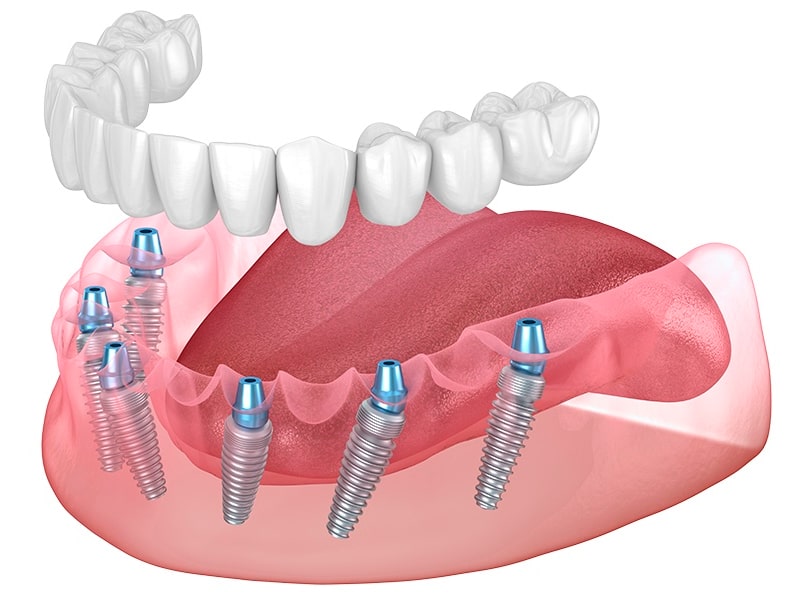 Нет всех зубов - методики имплантации