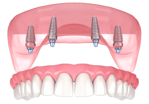 Сложные случаи имплантации