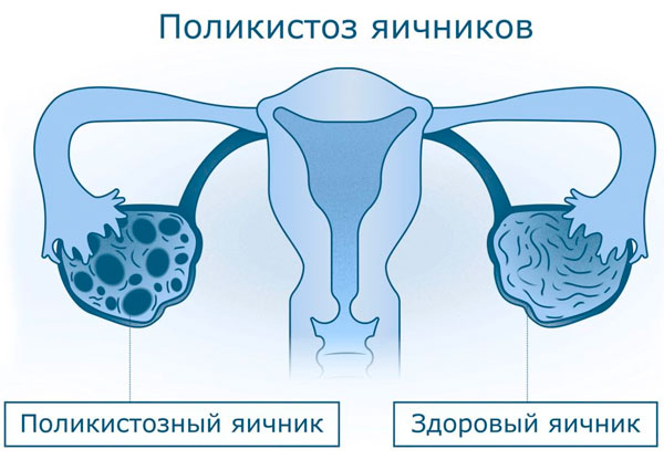 Синдром поликистозных яичников (СПКЯ) диагностика