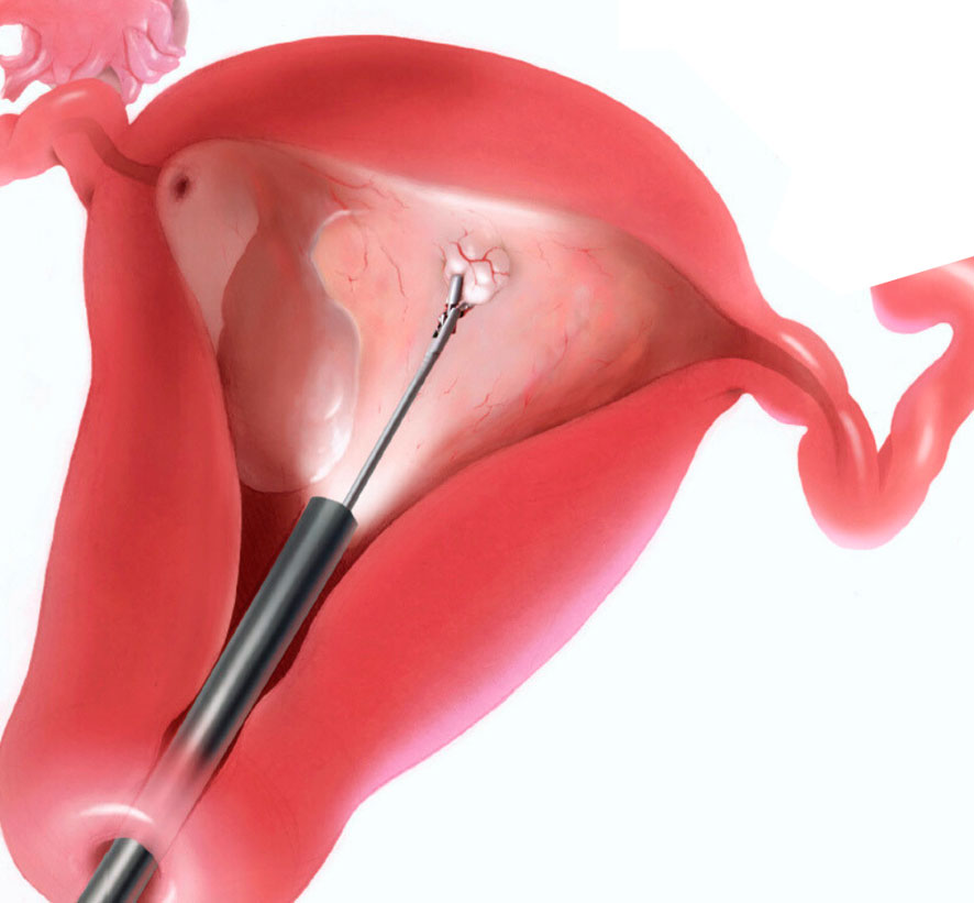 Удаление полипа эндометрия