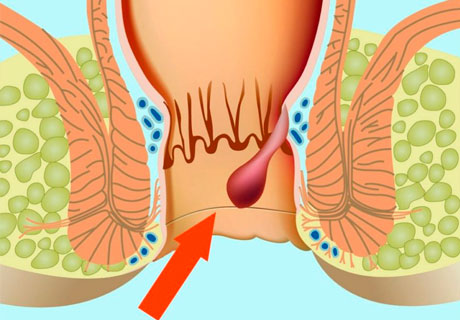 Стадии геморроя - симптомы, признаки и лечение 1, 2, 3 и 4 стадии