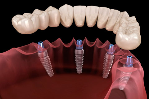 Dental Implantation All on 4