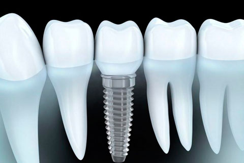 Two-stage dental implantation