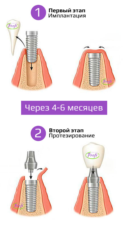 Двухэтапная имплантация зубов в Минске, цены