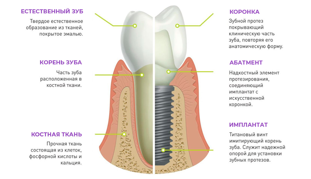 Имплантация зубов зубов в Минске, цены