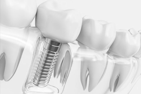 One-stage dental implantation