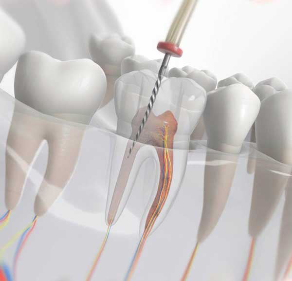 Пломбирование корневых каналов - лечение пульпита