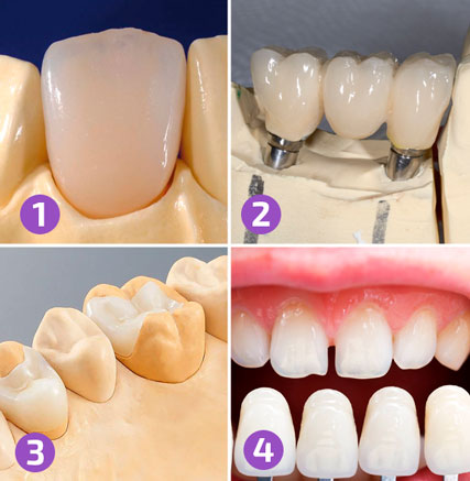 Prosthetics of teeth