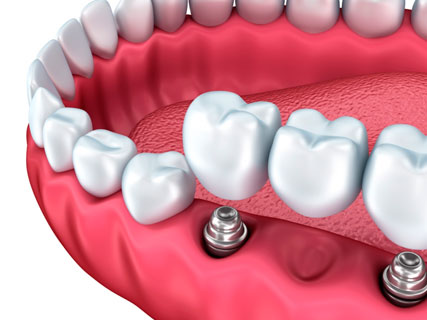 Prosthetics of teeth