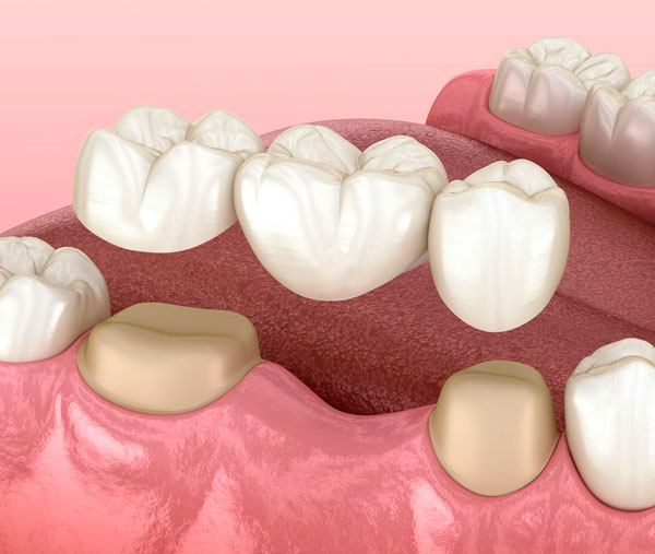 Зубные мосты в Минске, цены