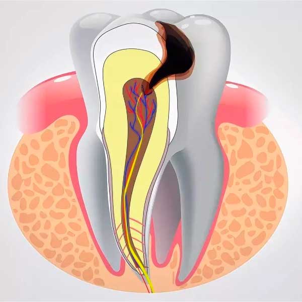 Лечение пульпита