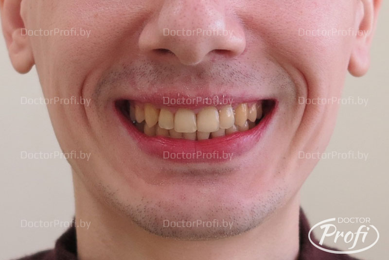 Исправление скученного положения зубов самолигирующими брекетами
