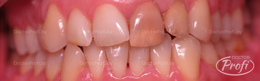 Восстановление эстетики передних зубов