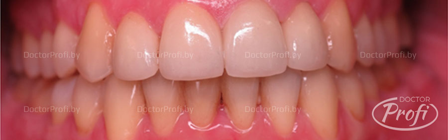 Восстановление эстетики передних зубов
