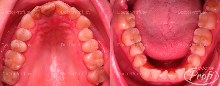 Restoration of the aesthetics of the front teeth