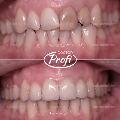 Restoration of the aesthetics of the front teeth
