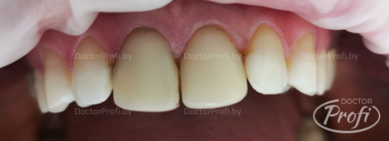 Photo-bleaching and installation of veneers on the front teeth