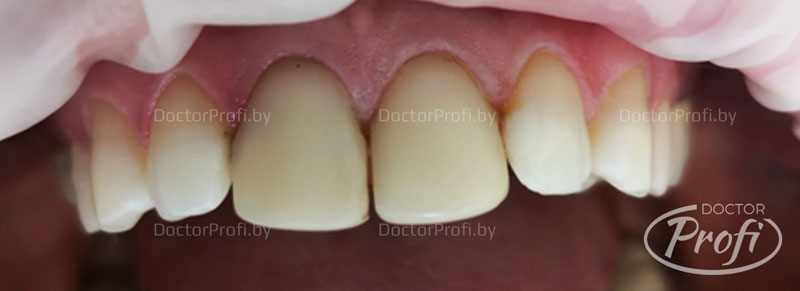 Фотоотбеливание и установка виниров на передние зубы