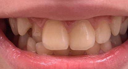 Ортодонтическое лечение на съемной пластинке