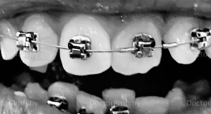 Ортодонтическое лечение самолигирующими брекетами