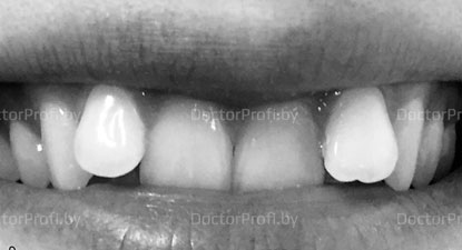 Исправление неровного положения зубов Damon Q