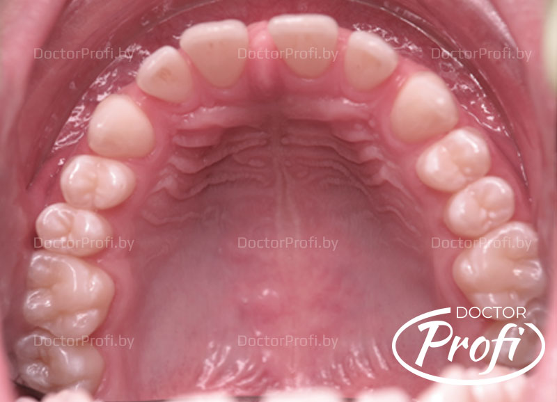 Устранение щелей (диастемы, тремы) между зубами