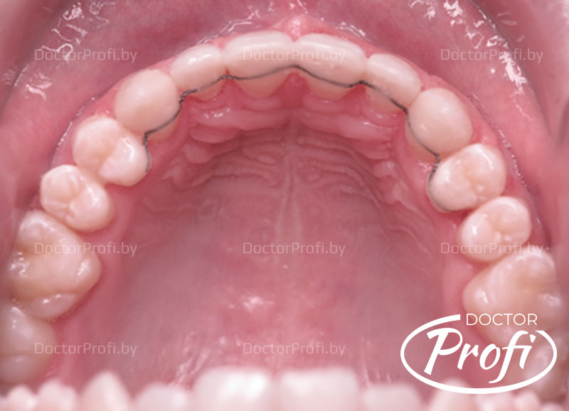 Устранение щелей (диастемы, тремы) между зубами