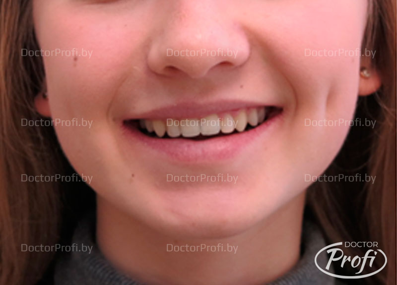 Устранение транспозиции и микродентии зубов