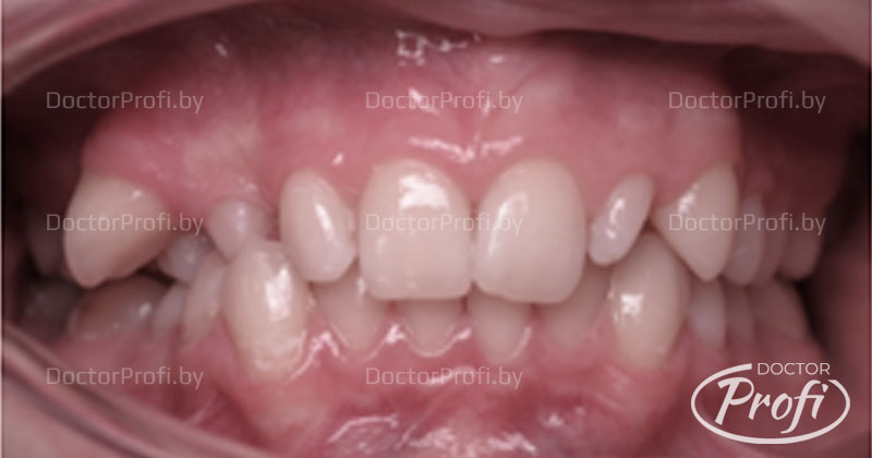 Устранение транспозиции и микродентии зубов