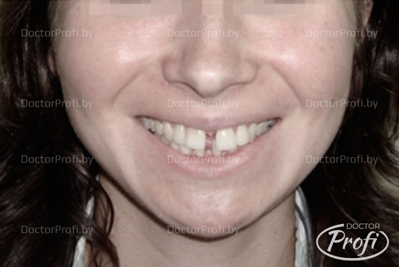 Устранение промежутка между зубами и чрезмерного наклона зубов 
