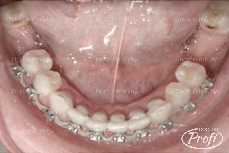 Устранение промежутка между зубами и чрезмерного наклона зубов 
